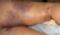 48 Cherie injuries (1) (Photo 1 of 2 photo(s)).